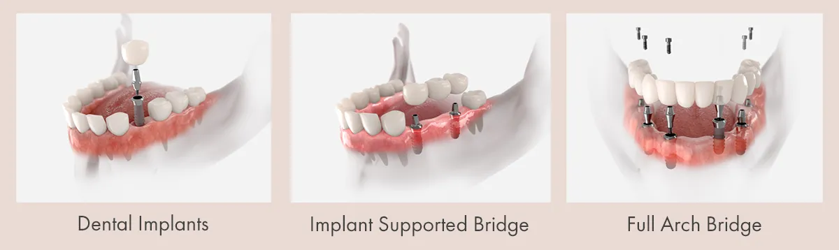Types of Dental Implants